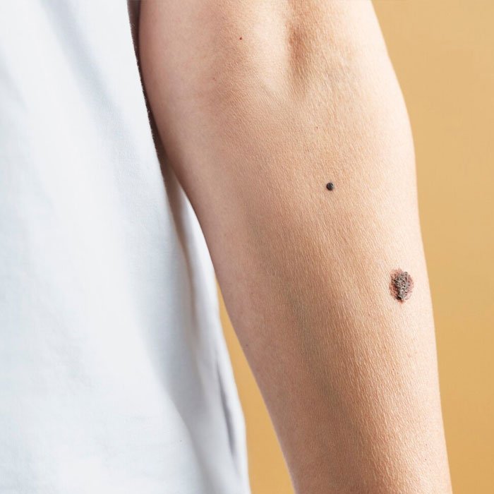 skin tags removal laser treatment Hyderabad