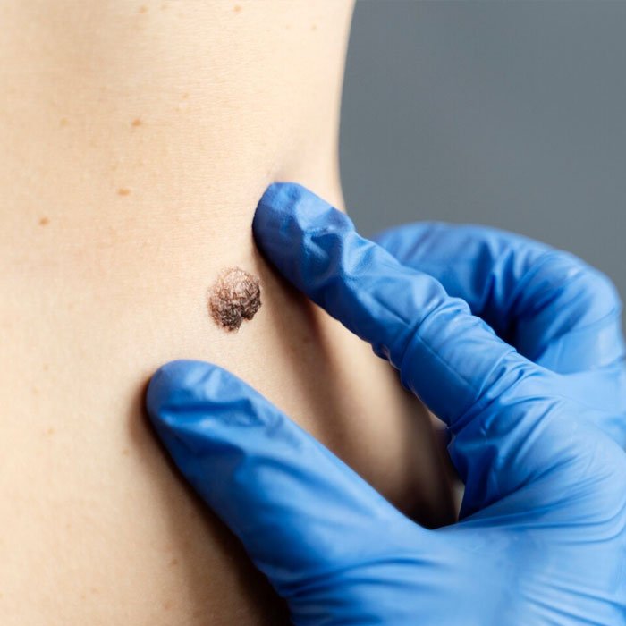 warts removal treatment in Hyderabad